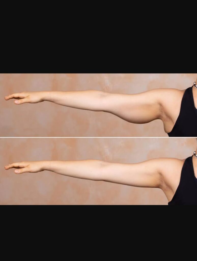 Remedies for fat arms