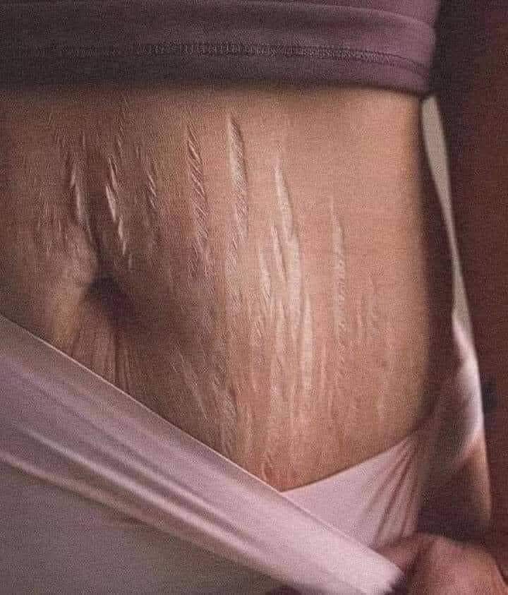 How to remove stretch marks