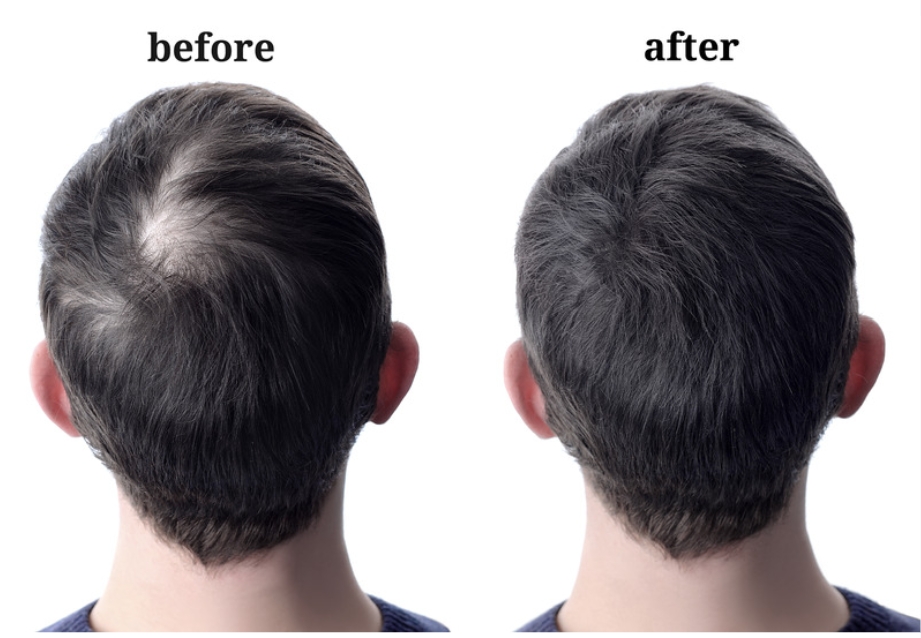 Remedies to regrow hair on bald patches