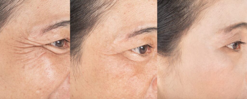 remedies-to-remove-under-eye-wrinkles-at-home-instantly