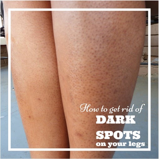 Remedies for Dark Spots after Waxing 