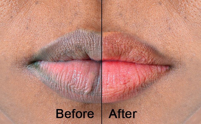 remedies for pink lips