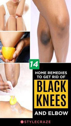 Remedies to get rid of black knees