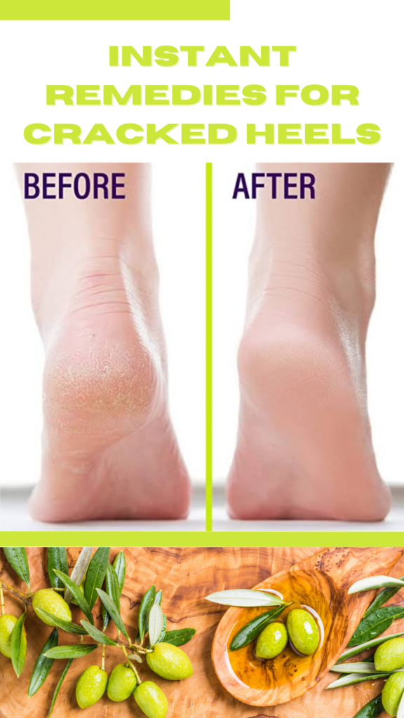 Five best home remedies for cracked heels for instant result