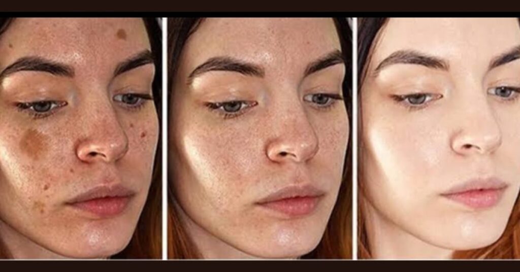 5 Natural Solutions for Improving Skin Tone and Reducing Pigmentation