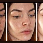 5 Natural Solutions for Improving Skin Tone and Reducing Pigmentation