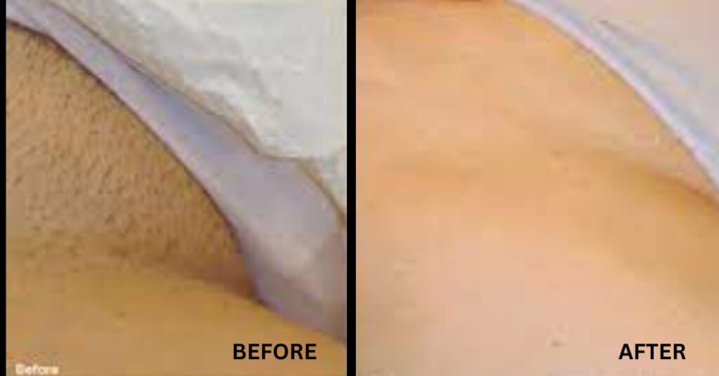 Home Remedy for Razor Bumps and Cleaning of Bikini Areas