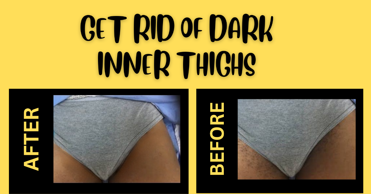 remedy-to-get-rid-of-dark-inner-thighs-v-beautify