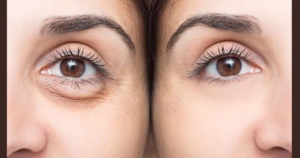 Eye Bags and Dark Circle Instant Home Remedies and Causes