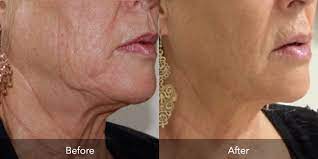 natural face lifting remedies