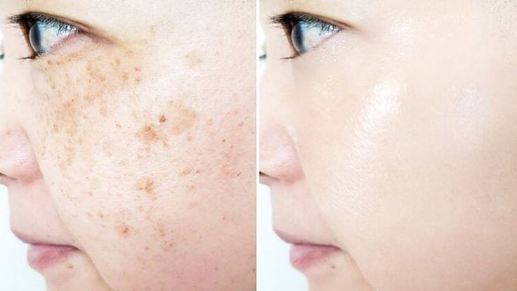 natural remedies for hyperpigmentation