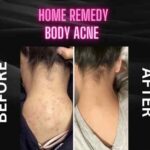 DIY Solutions for Body Acne