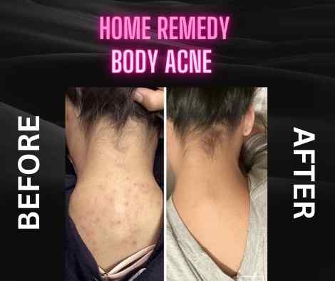 DIY Solutions for Body Acne