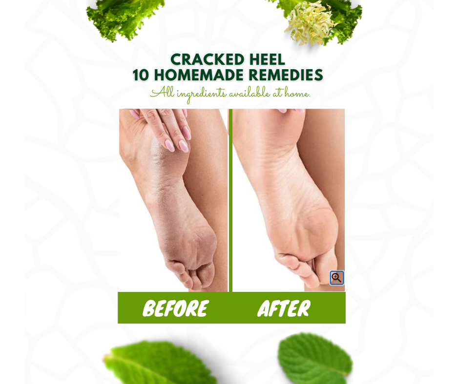 CRACKED HEELS 10 HOMEMADE REMEDIES