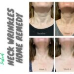 Natural Remedies to Diminish Neck Wrinkles
