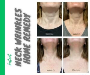 Natural Remedies to Diminish Neck Wrinkles