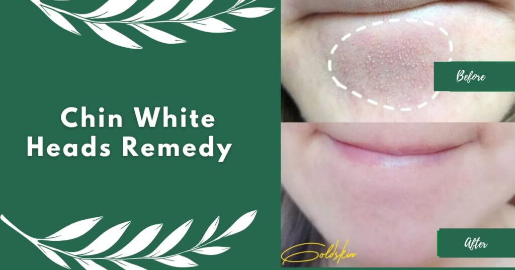 Natural Remedies for Chin Whiteheads