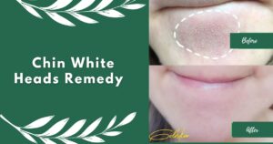 Natural Remedies for Chin Whiteheads