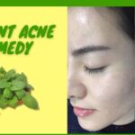 Effective Home Remedies for Acne
