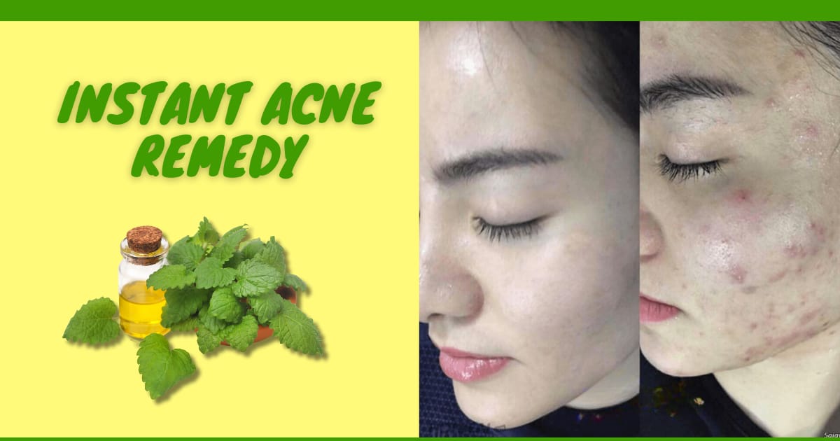Effective Home Remedies for Acne V Beautify