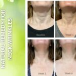 As we get older especially 50 plus years of age, the neck wrinkles start to appear. There are many treatments available which are either surgical treatments or there are many cosmetic products available in the market both options are very expensive