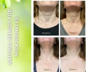 As we get older especially 50 plus years of age, the neck wrinkles start to appear. There are many treatments available which are either surgical treatments or there are many cosmetic products available in the market both options are very expensive 