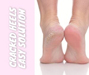 Tackling Cracked Heels with Natural Home Remedies