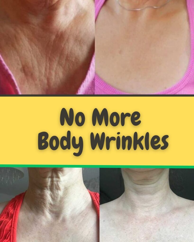 NO MORE BODY WRINKLES WITH NATURAL REMEDY