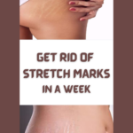 GET RID OF STRETCH MARKS IN A WEEK
