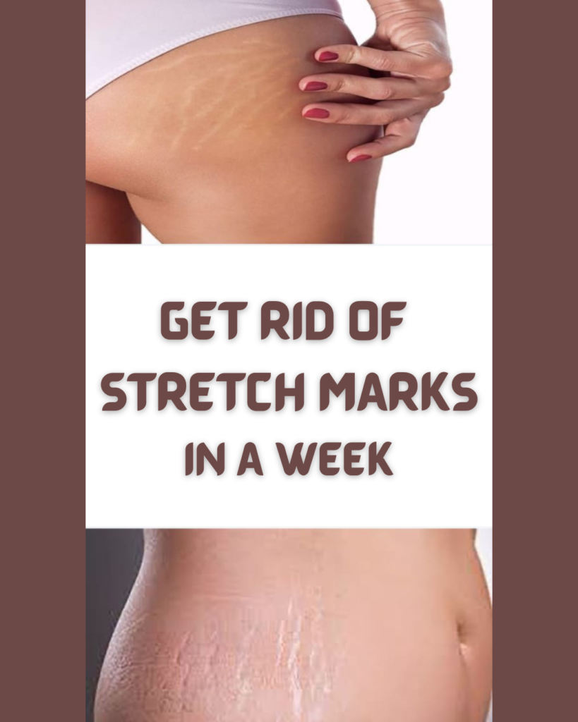 GET RID OF STRETCH MARKS IN A WEEK