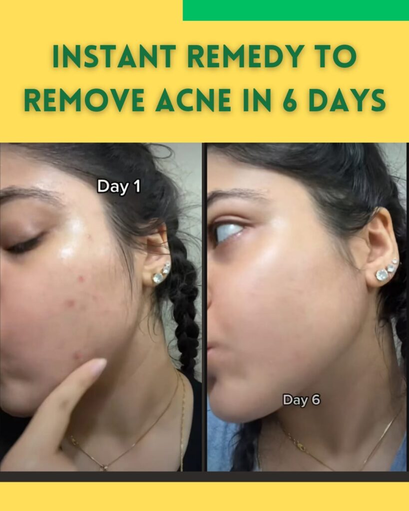 Home Remedies to Remove Acne in 6 Days