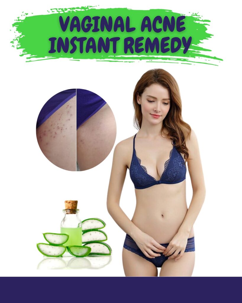 Instant Home Remedies for Vaginal Acne