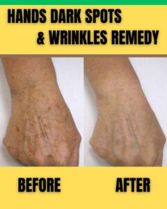 HANDS DARK SPOTS & WRINKLES REMEDY
