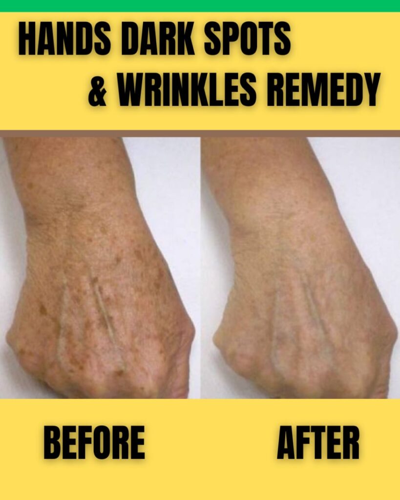 HANDS DARK SPOTS & WRINKLES REMEDY