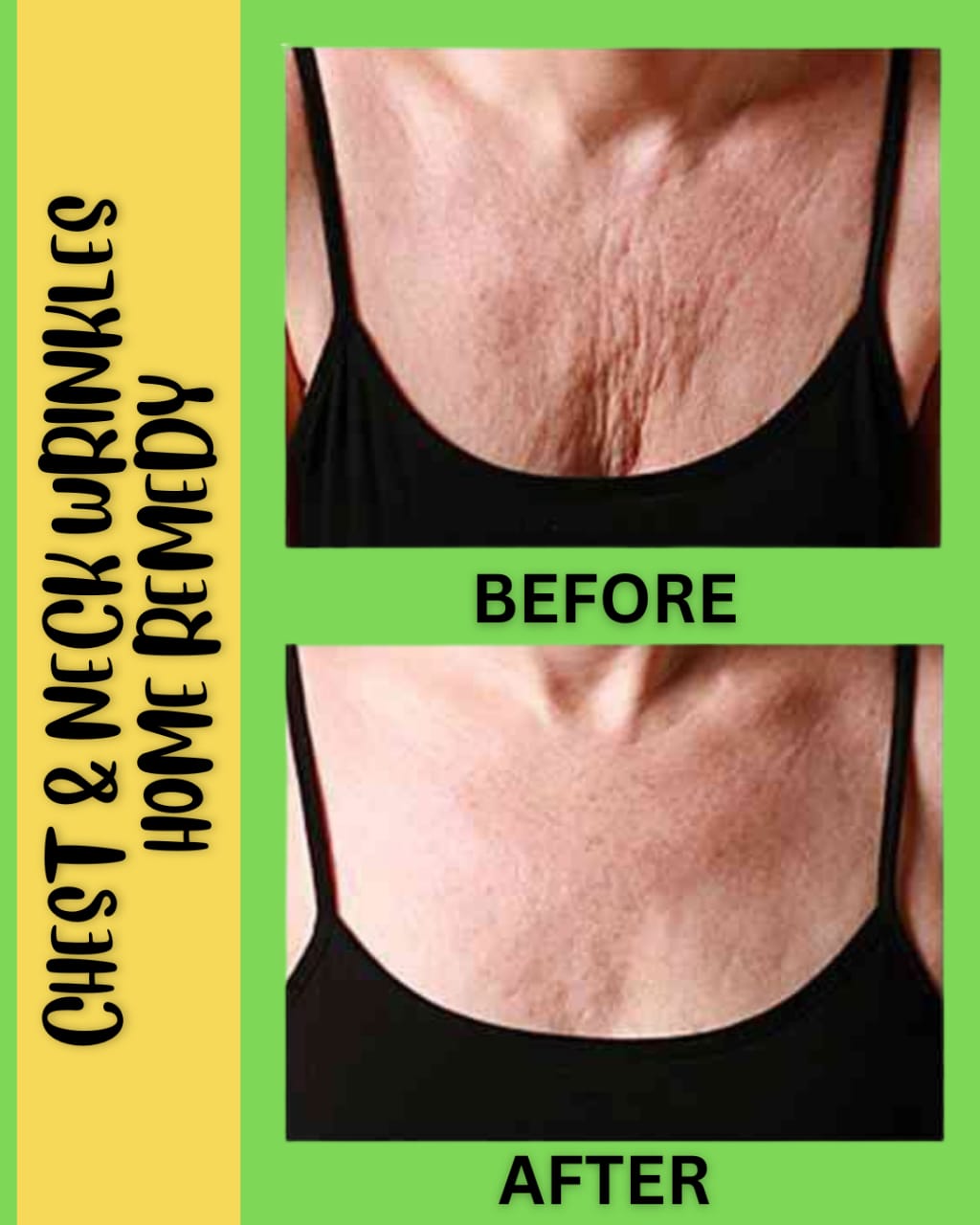 Home Remedies for Neck and Chest Wrinkles