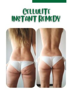 Natural Remedies for Cellulite Home Treatments for Different Age Groups