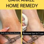 Dark Ankles Home Remedy