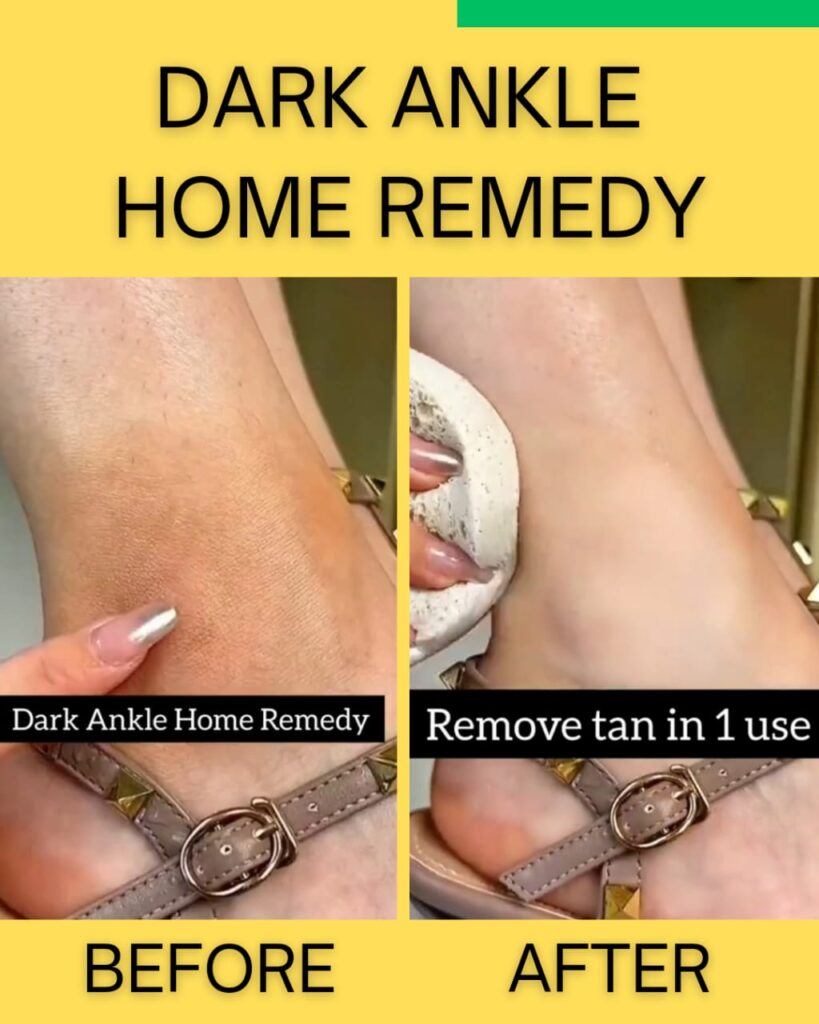 Dark Ankles Home Remedy