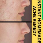 INSTANT HOMEMADE ACNE REMEDY