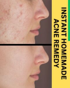 INSTANT HOMEMADE ACNE REMEDY
