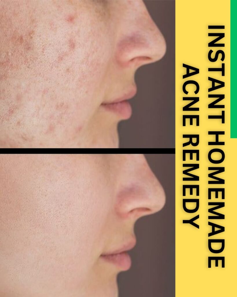 INSTANT HOMEMADE ACNE REMEDY