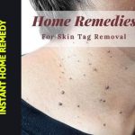 REMOVE SKIN TAGS