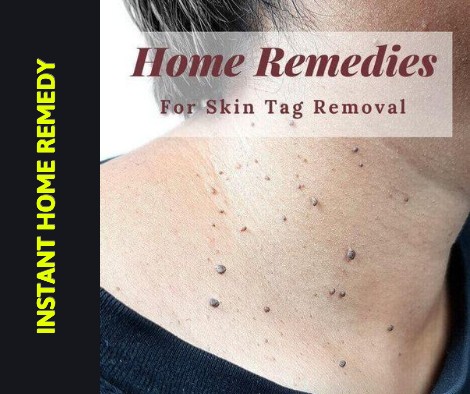 REMOVE SKIN TAGS