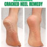 Effective Homemade Remedies for Cracked Heels