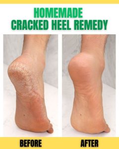 Effective Homemade Remedies for Cracked Heels