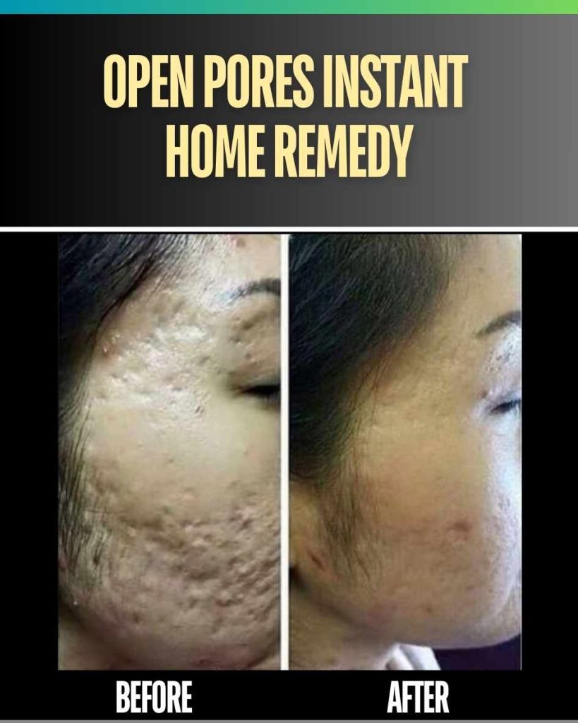 OPEN PORES INSTANT HOME REMEDY