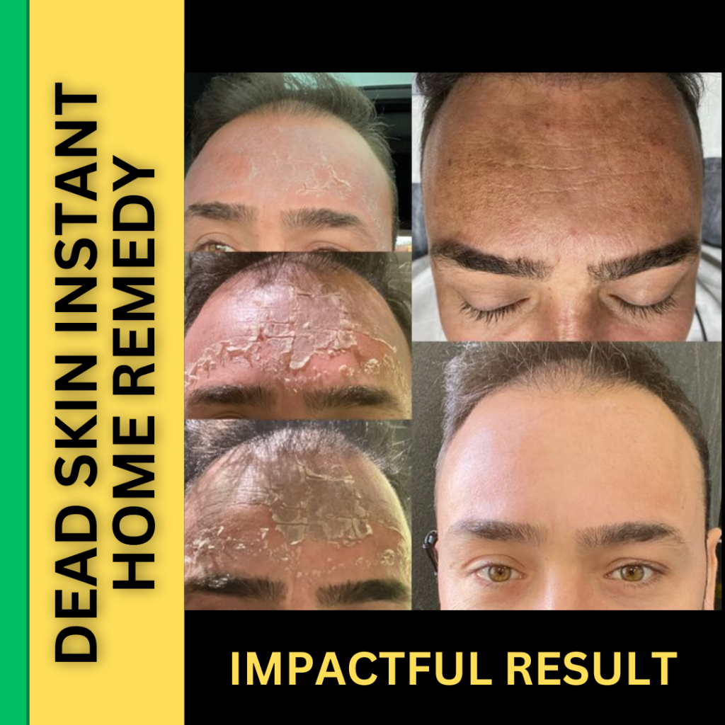 Instant Home Remedies for Removing Dead Skin