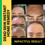 Instant Home Remedies for Removing Dead Skin