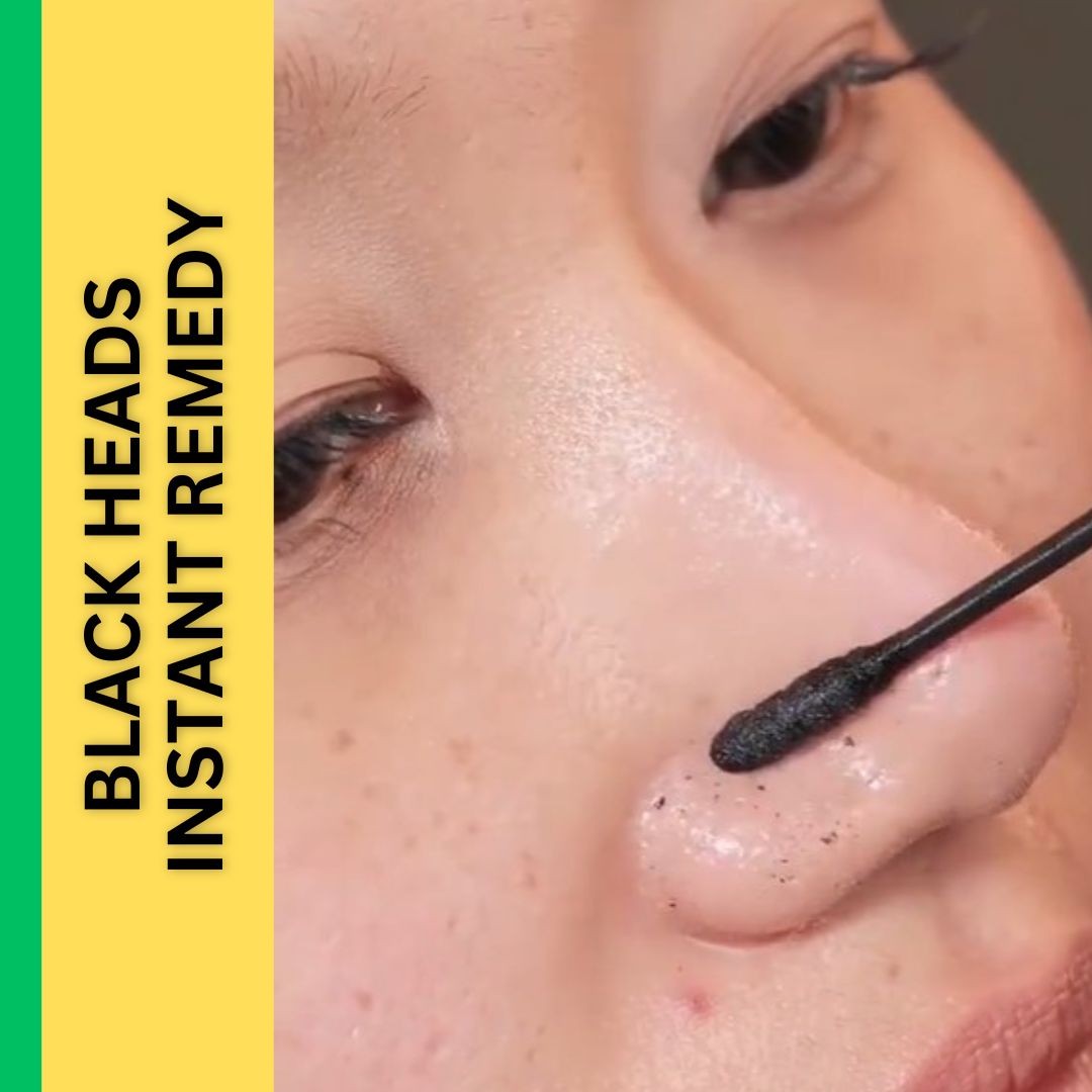 Instant Home Remedies for Blackheads V Beautify