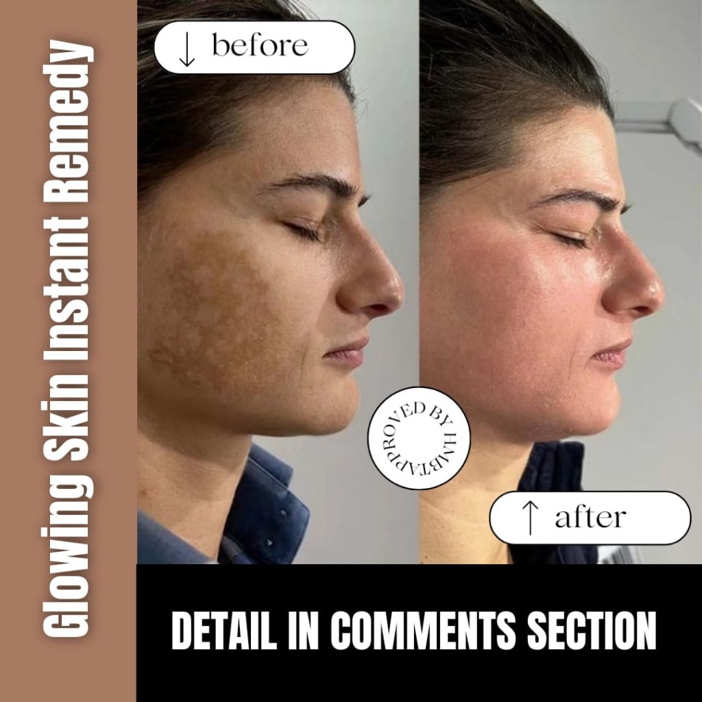 Glowing Skin Instant Remedy Home Remedies for Every Skin Type